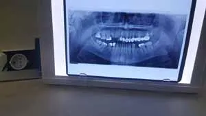 negatoskop snimak zuba