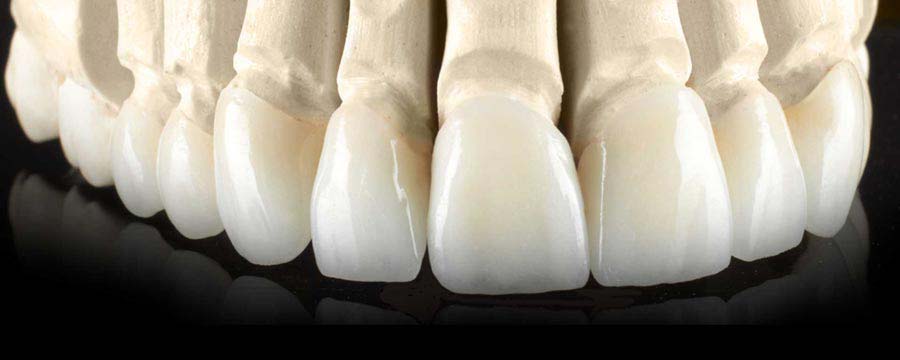 bezmetalne krunice za zube
