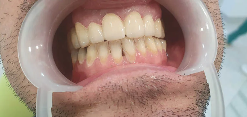 cirkonijumske navlake za zube primer