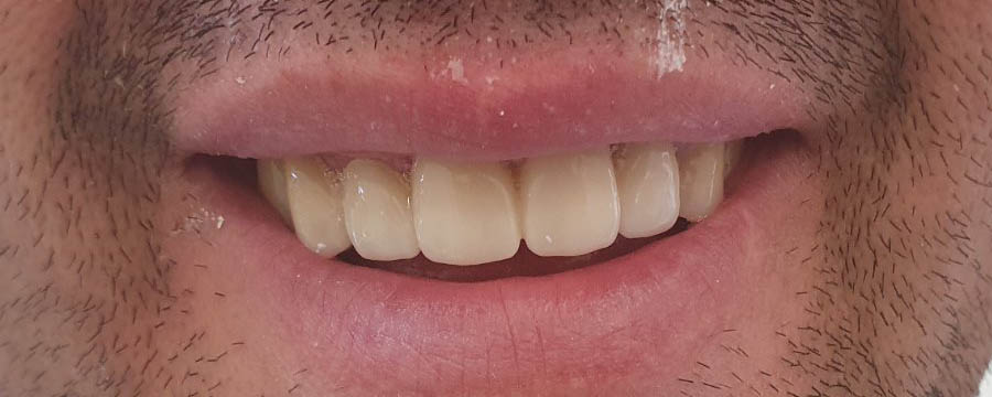 navlake za zube primer