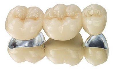 Metalokeramičke krunice za zube
