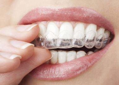 silikonske navlake za zube