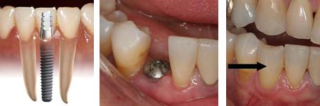 dental tourism implants