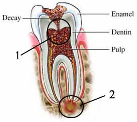 vadjenje živca iz zuba
